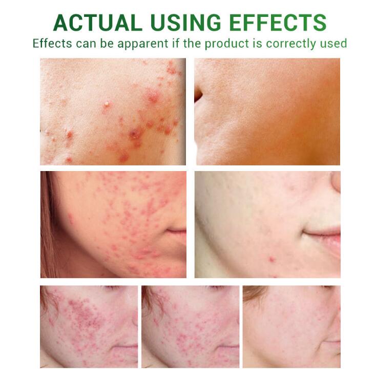 Acne Treatment & Repair Serum — product photo 4